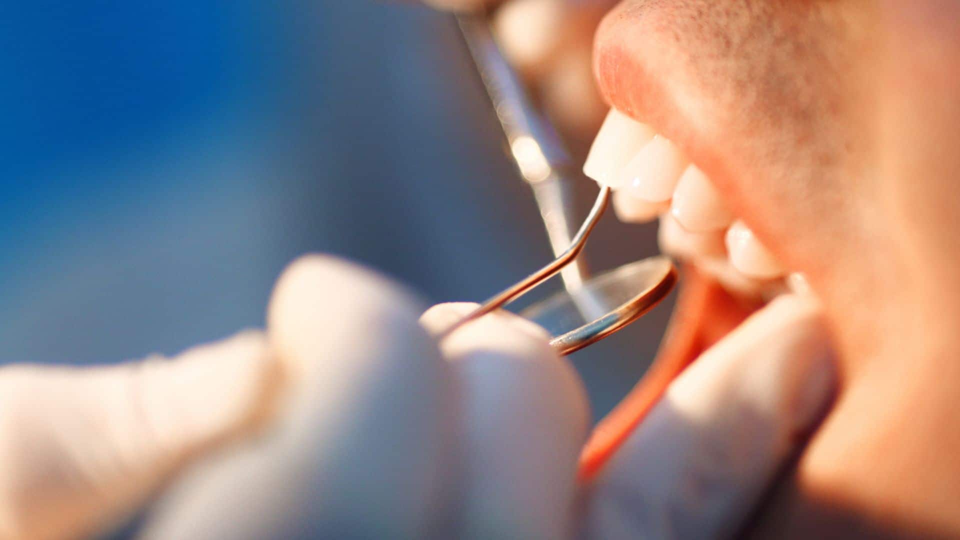 Tooth Extraction