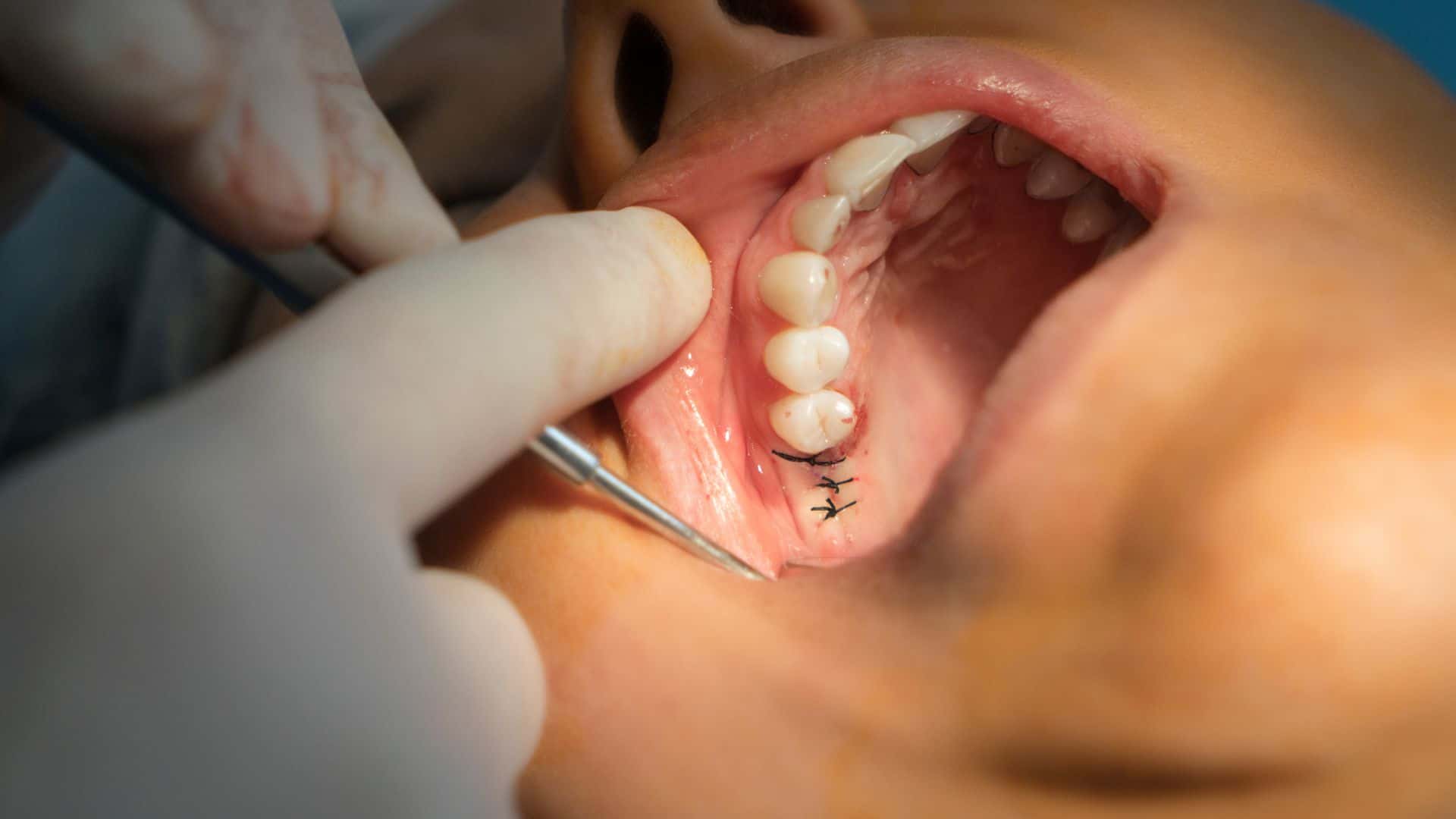 Bone Graft