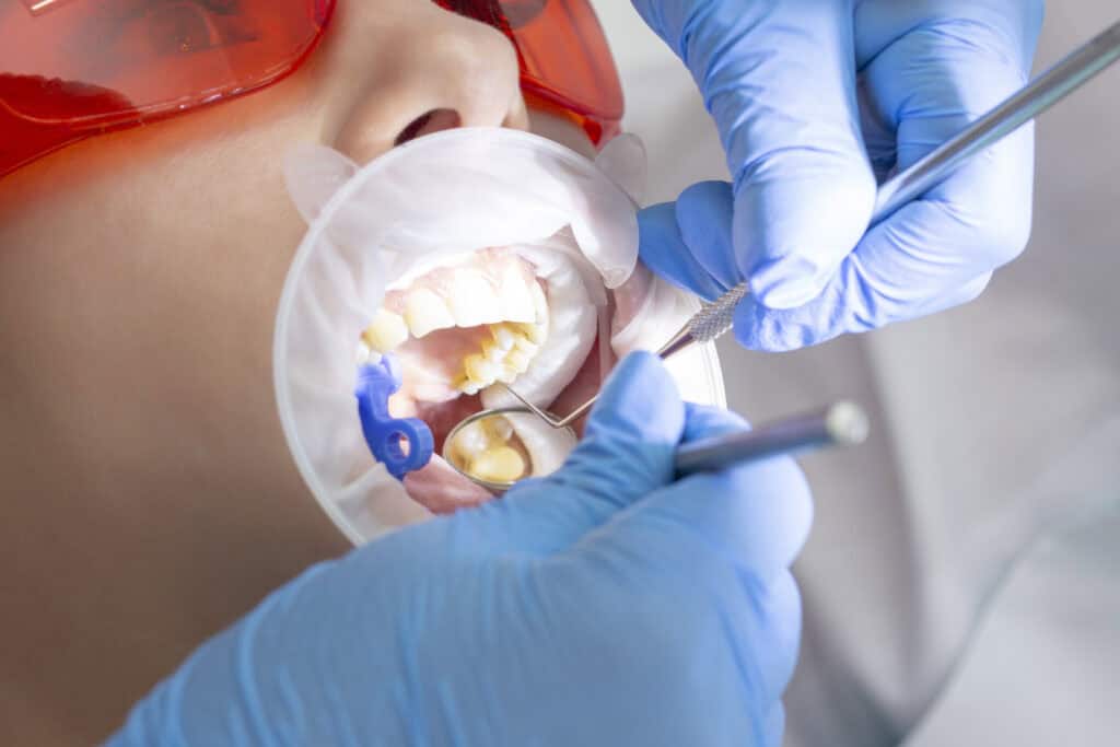 tooth extraction