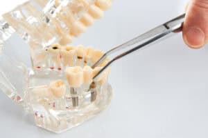 Dental technician placing the fixed partial denture, dental bridge on the screw implants, close-up. Dentists tooth model with screw implant for teaching, learning showing teeth and gums